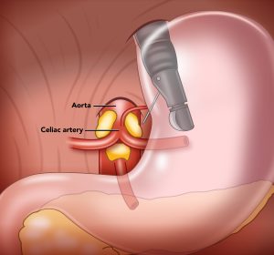 Celiac Plexus