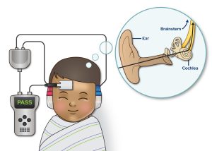 Newborn Screening for Hearing