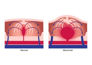 Placental Accreta Spectrum
