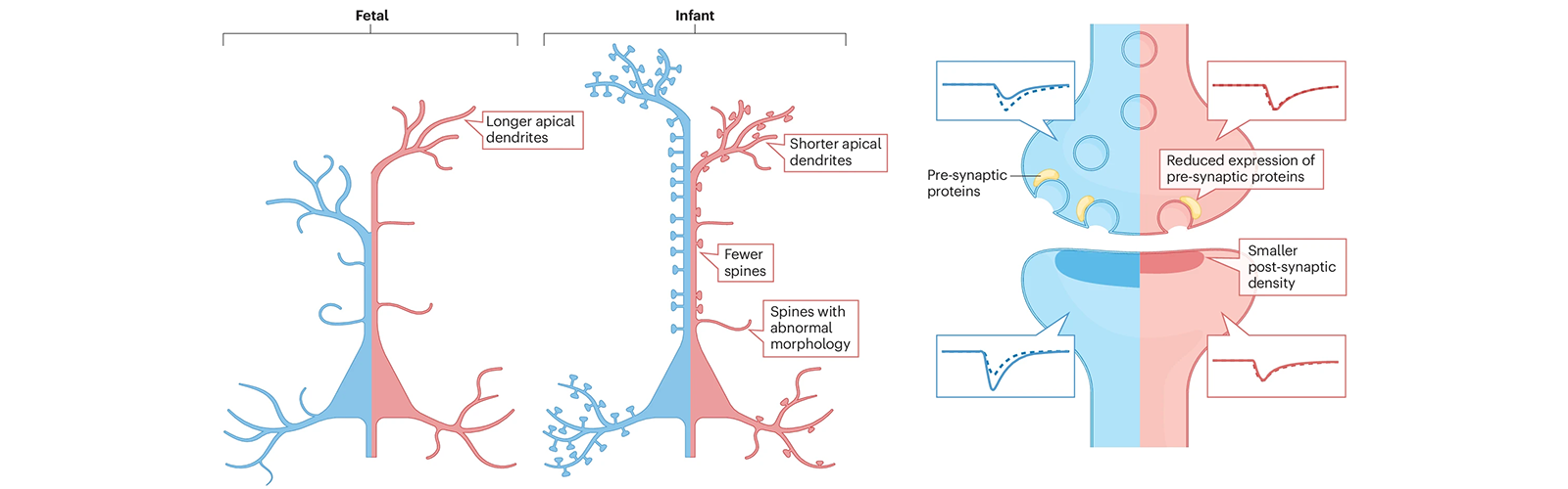 Down syndrome review article - Anita Bhattacharyya